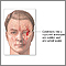 Ruptura de aneurisma intracraneal