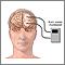 Monitor de ondas cerebrales