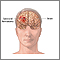 Hematoma subdural