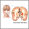 Hemorragia intracerebral