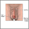 Estenosis meatal