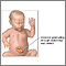Hernia abdominal infantil (gastrosquisis)