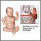 Hernia diafragmática infantil