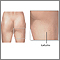 Celulitis