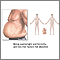 Factores de riesgo de diabetes