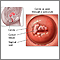Frotis de Papanicolaou y cáncer cervical