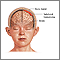 Hematoma subdural
