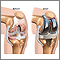 Prótesis de reemplazo de la articulación de la rodilla