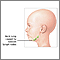 Protuberancia en el cuello