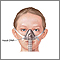 PPCVR Nasal
