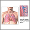 Émbolo pulmonar