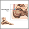 Bursitis retrocalcánea