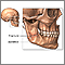 Fractura mandibular