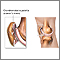 Rodilla de corredor