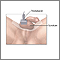 Ultrasonido testicular