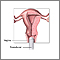 Ultrasonido transvaginal