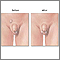 Antes y después de la reparación testicular