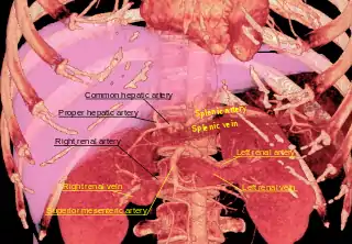 Tomografía axial computarizada renderizada en 3D, mostrando la arteria esplénica arriba y a la derecha.