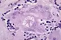 Cuerpo de asteroide en sarcoidosis.
