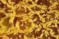 Colesterolosis de la vesícula biliar (imagen bruta)