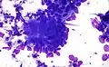Adenocarcinoma colorrectal. Tinción de Field .