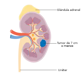 Cáncer de riñón en etapa 1