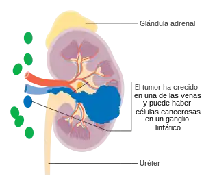 Cáncer de riñón en etapa 3
