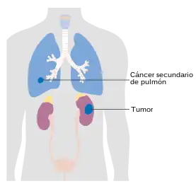 Cáncer de riñón en etapa 4