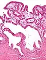 Micrografía de colesterolosis de la vesícula biliar