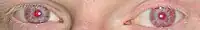 Ojos rojos de una persona albina.