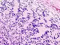 Schwannoma periférico Antoni tipo A