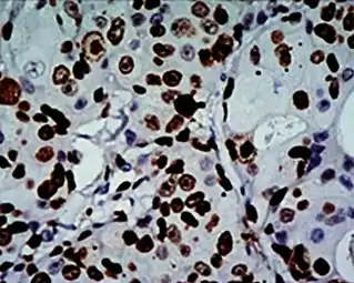 Alta expresión de Ki-67 en un cáncer de mama invasivo, con los núcleos del cáncer teñidos (marrón). Hay positividad de células tumorales en el 70% de las células:                                                                                 Índice de etiquetado Ki-67 = 70%