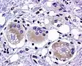 Reacción contra cuerpo extraño gigantocelular contra una fuga de silicona de un implante de mama. Tinción hematoxilina-eosina.