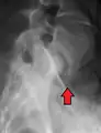 Anterolistesis L5/S1