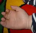 Sindactilia de la mano