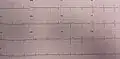 EKG en un paciente con síndrome de Wellens cuando tiene dolor en el pecho
