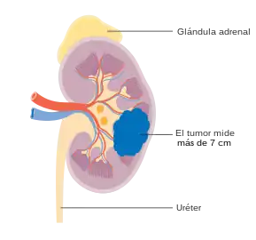 Cáncer de riñón en etapa 2