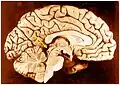 El colículo inferior (punto rojo) en un cerebro humano que se ha cortado por la mitad para mostrar algunas de las áreas subcorticales.