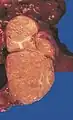 A locally invasive circumscribed thymoma (mixed lymphocytic and epithelial, mixed polygonal and spindle).