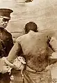 Soldado con quemaduras severas de gas mostaza en su cuerpo y brazos hacia 1918. Estas quemaduras son lo suficientemente severas como para poner en riesgo la vida.