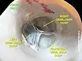 Válvula aórtica