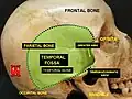 Visión lateral del cráneo, en la que se observa la fosa temporal (en inglés, temporal fossa), la cual incluye al hueso parietal, además del hueso frontal y hueso occipital.