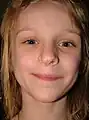 La misma niña a los 8 años de edad. Nótese cómo la cicatriz casi ha desaparecido.