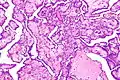 Mesotelioma